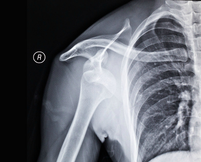 X-Ray of a shoulder dislocation