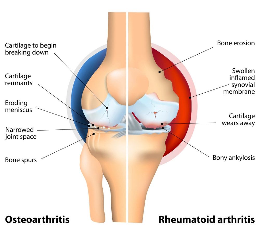 a fazett ízületek osteoarthritis hatékony gyógyszer a lábak ízületi fájdalmaira